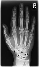 Röntgenaufnahme einer Hand